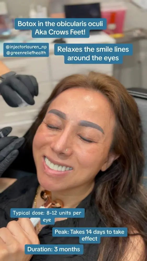 Botox in the orbicularis oculi, aka crow's feet