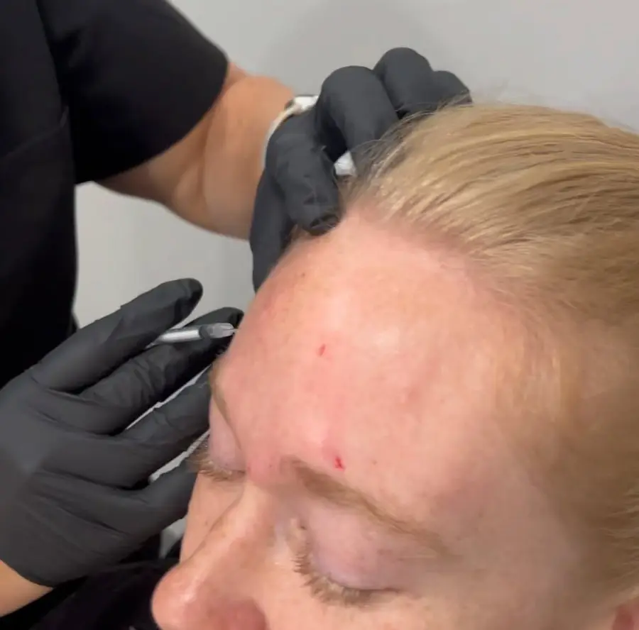 Forehead lines