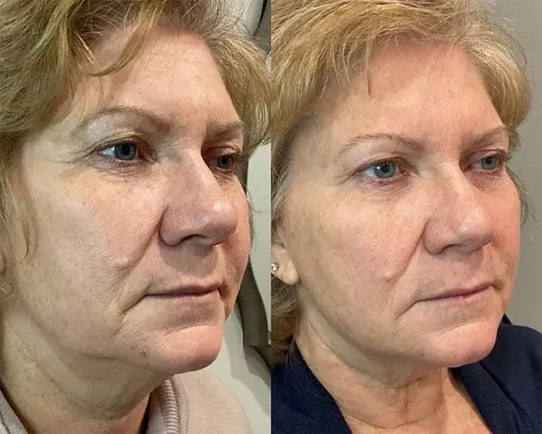 Before and after a treatment at Green Relief Health