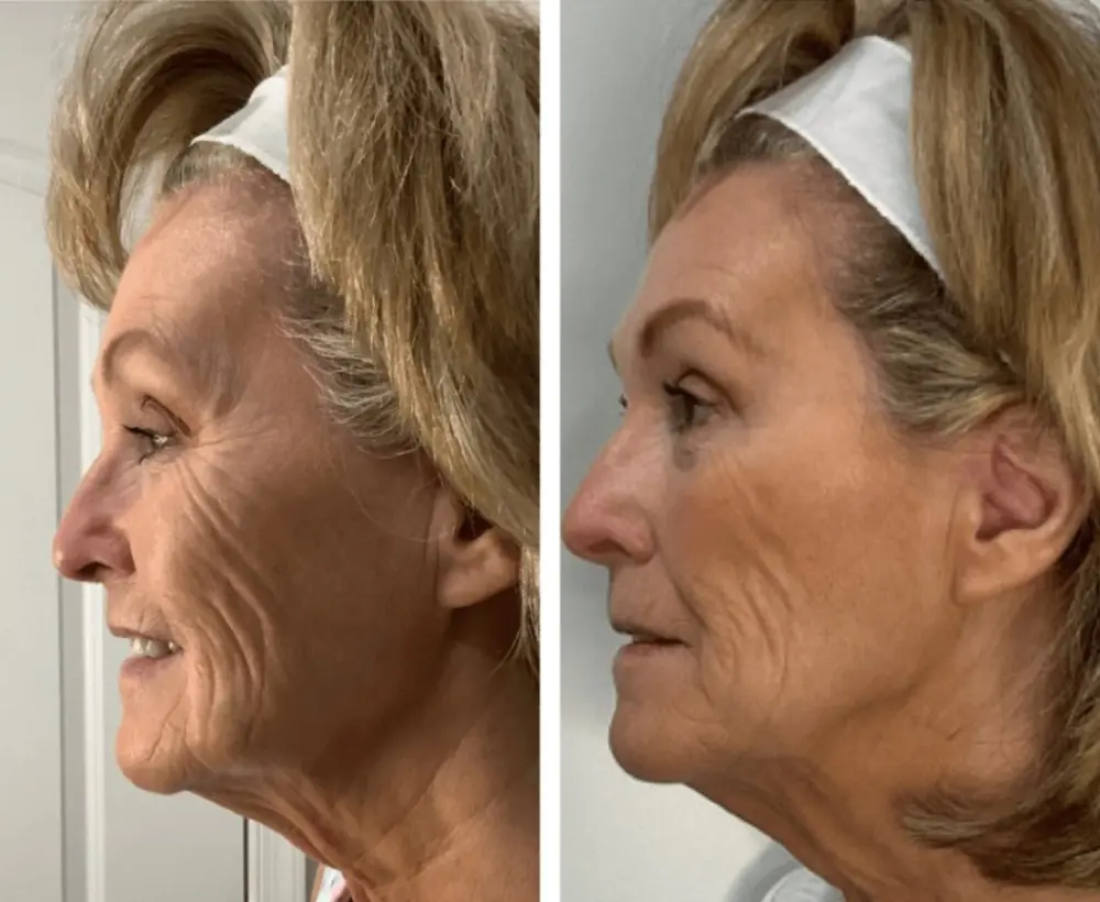 Before and after a treatment at Green Relief Health