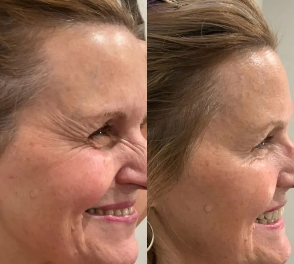 Before and after a treatment at Green Relief Health