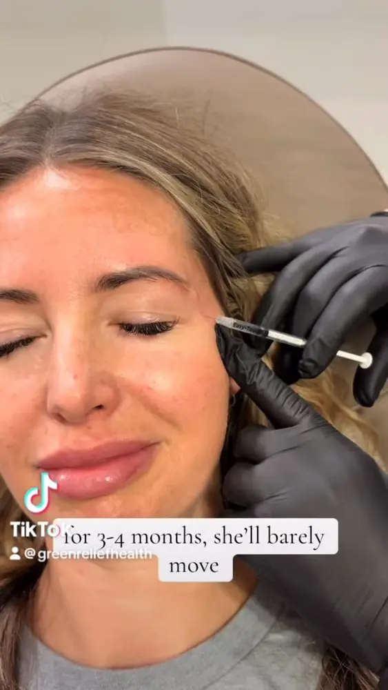 Crow's feet, three to four months of results