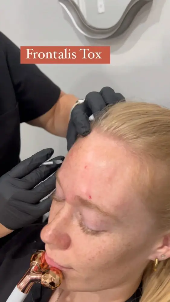Frontalis tox, a forehead treatment