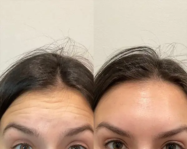 Before and after a treatment at Green Relief Health