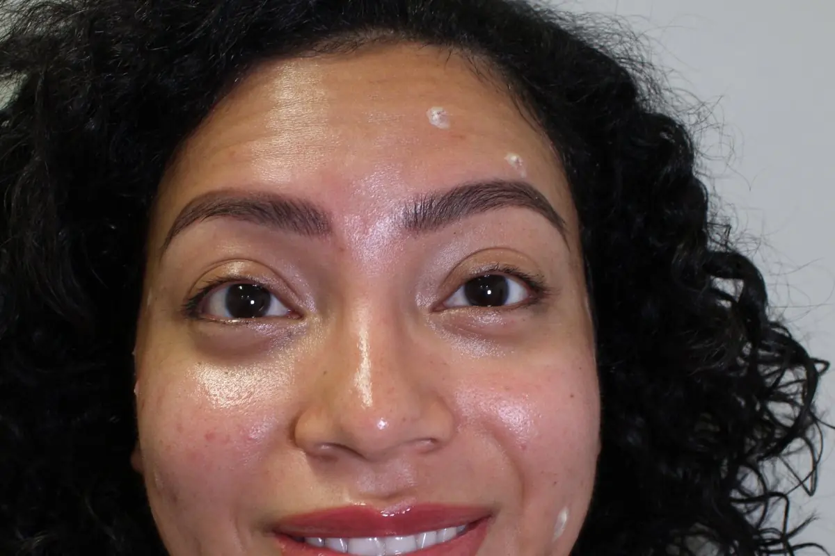 Skin before a dermaplane facial at Green Relief Health