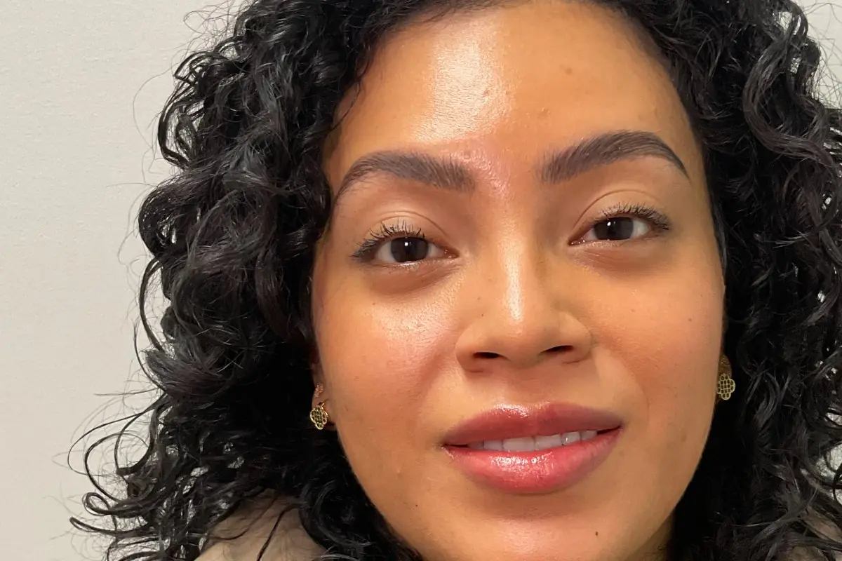 Skin after a dermaplane facial at Green Relief Health